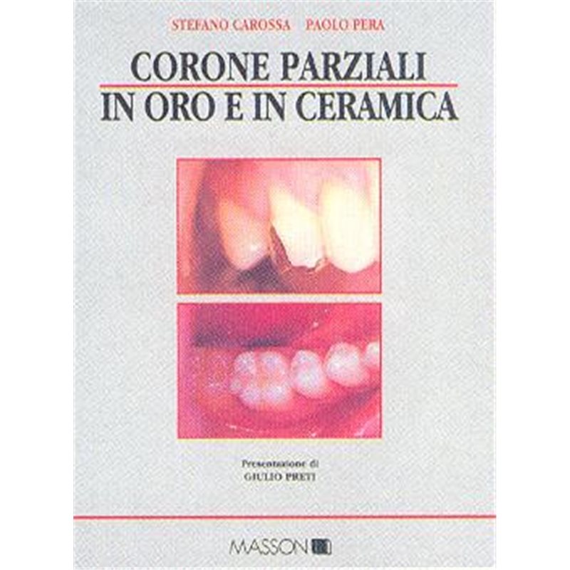 Corone parziali in oro e in ceramica